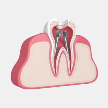 Root Canal Therapy in Liberty Hill, TX: What You Need to Know